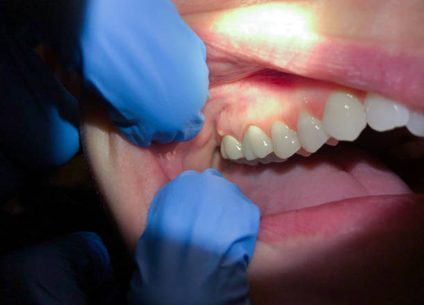 Best Cracked Tooth Emergency Dentist  in Norton, OH